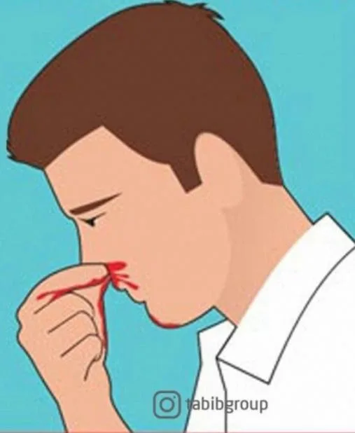 صورة: الرعاف