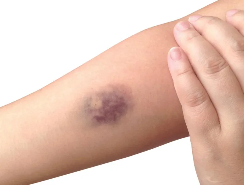 صورة: الكدمة